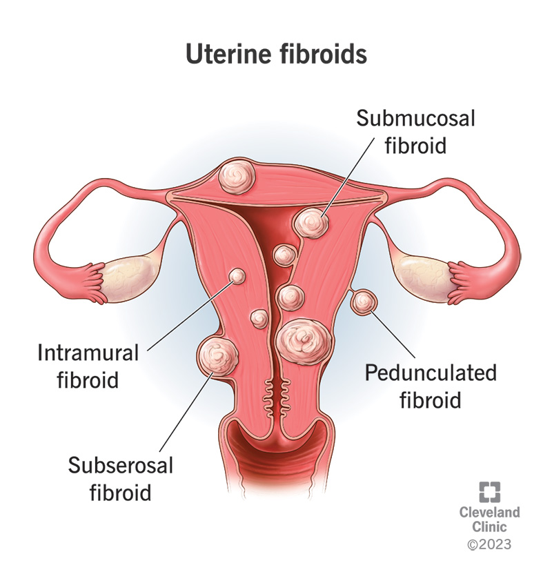 The type of Fibroid and their locations