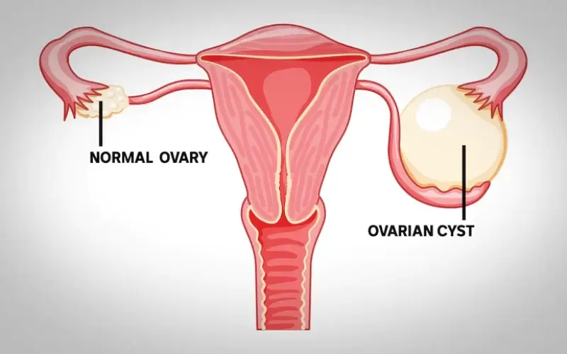 Ovarian-Cysts-in-Reproductive-Age-Women-Diagnosis-and-Management